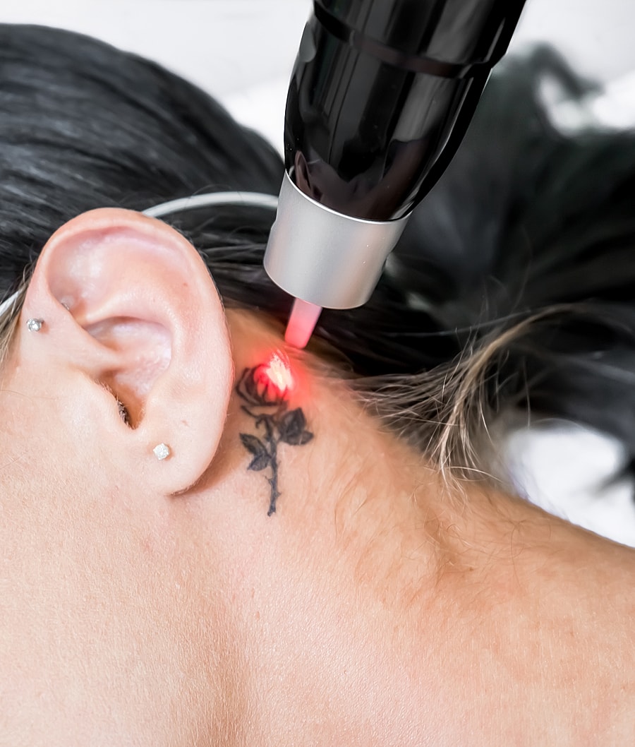 Laser treatment on a tattooed rose design.
