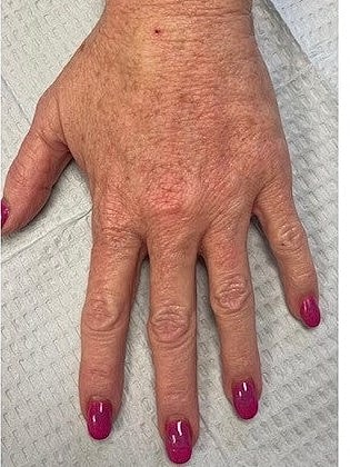 Restylane® Before & After