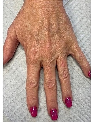 Restylane® Before & After