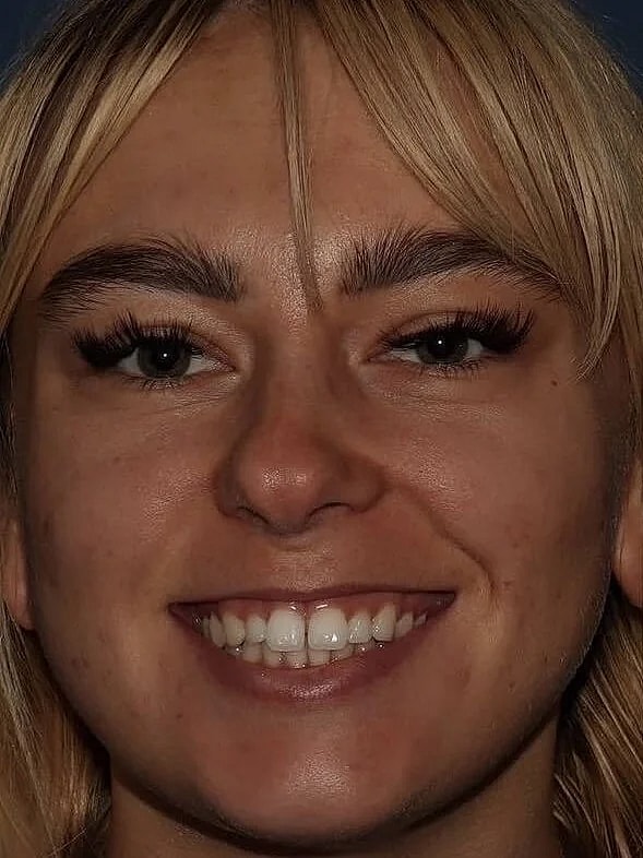 Restylane® Before & After