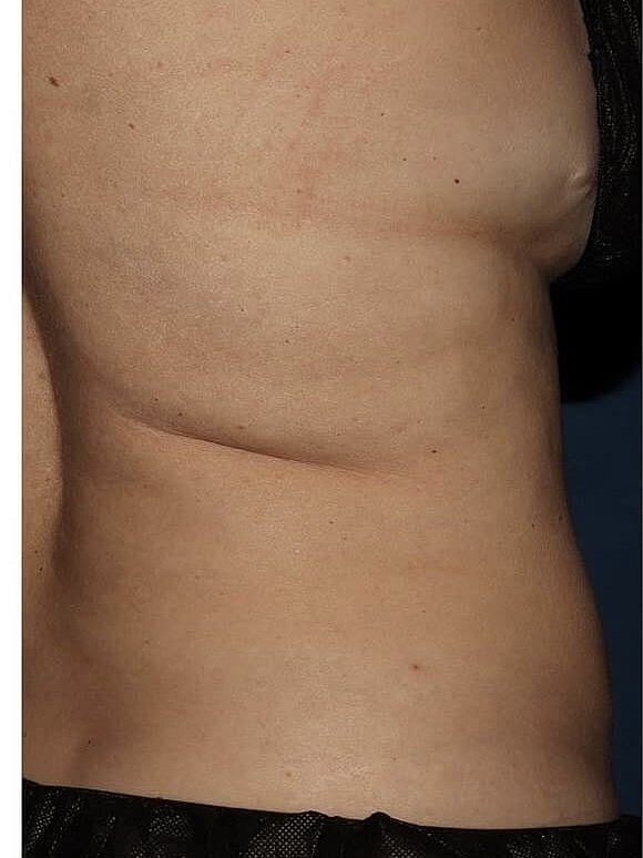 CoolSculpting® Before & After