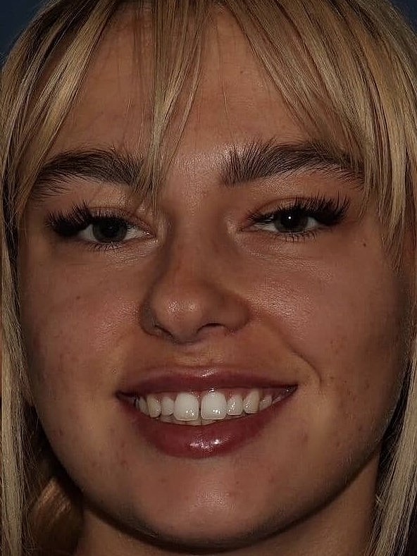 JUVÉDERM® Before & After