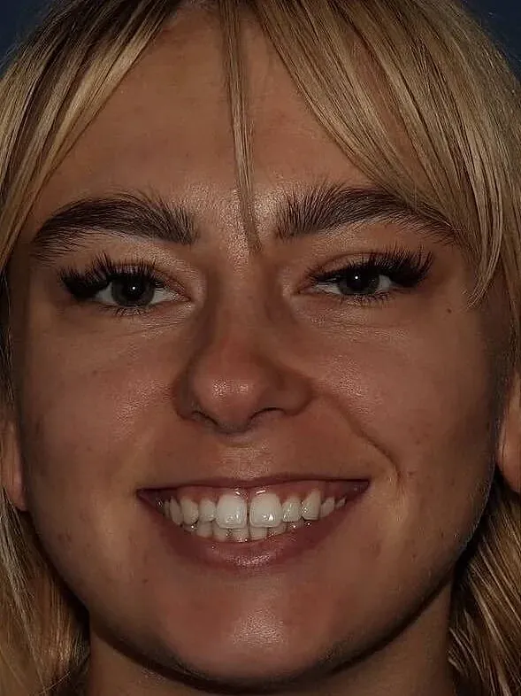 JUVÉDERM® Before & After