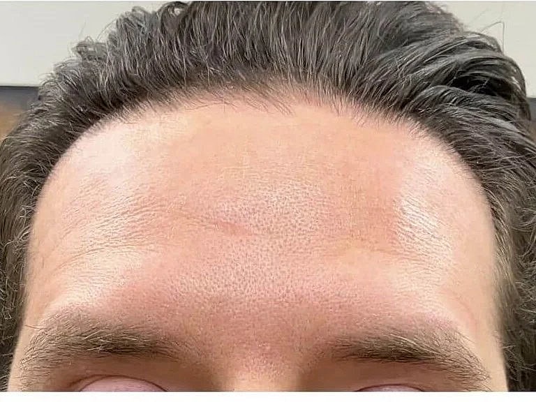 Close-up of a person's forehead and hairline.