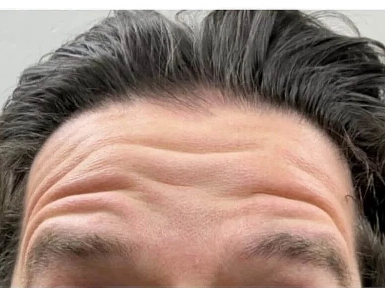 Close-up of a forehead with wrinkles and hair.