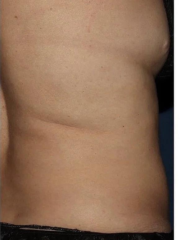 Side view of a torso without clothing.
